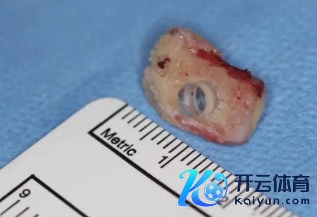 加拿大首例“以牙换眼”手术开启 盲东谈主重见光明但愿